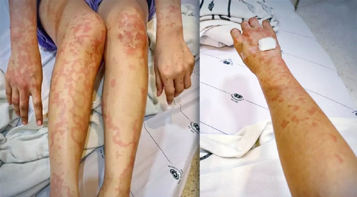 Patiënt klaagt vrouw aan voor het gebruik van haar foto om allergie te claimen na een Sinovac-prik
