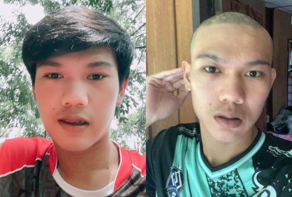 19-jarige jongen uit Phuket beweert dat Sinovac-vaccin ervoor zorgde dat zijn haar uitviel