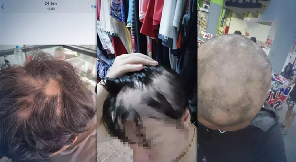 Facebook-pagina in Thailand lanceert campagne over klachten over ernstig haarverlies door Covid19 vaccinaties