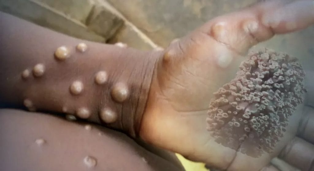 Thailand bevestigt eerste vrouwelijke apenpokken besmetting