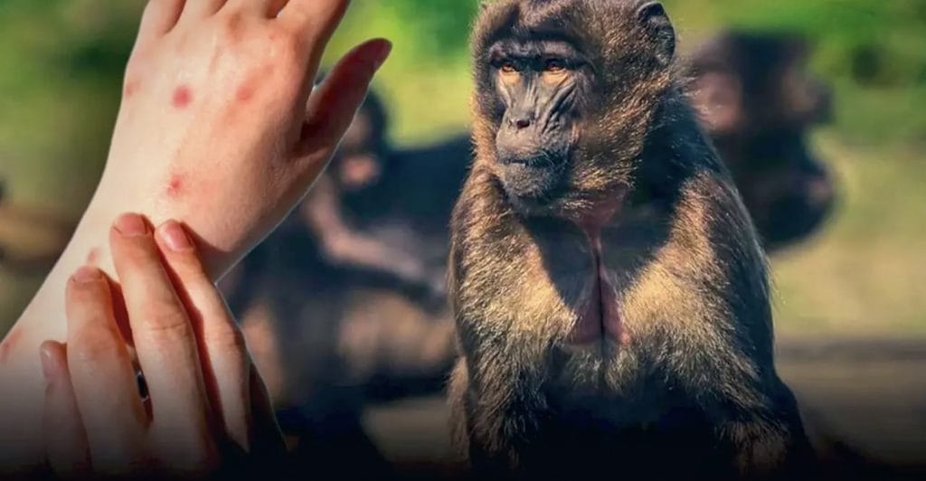 Thaise man krijgt in Qatar de apenpokken en is waarmee de 8e bevestigde infectie in Thailand 