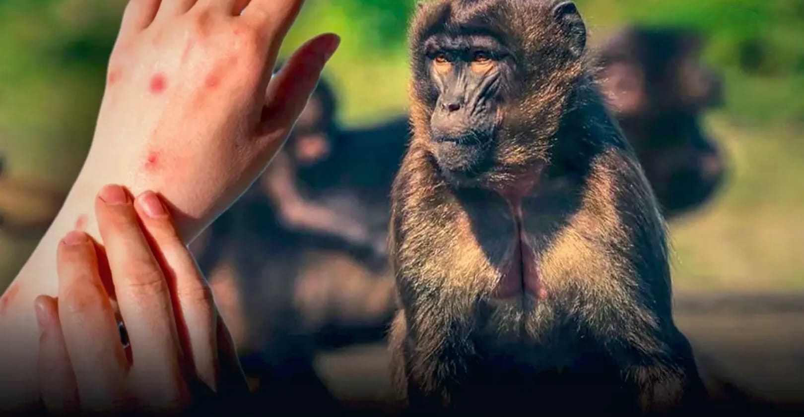 Thaise man krijgt in Qatar de apenpokken en is waarmee de 8e bevestigde infectie in Thailand&nbsp;