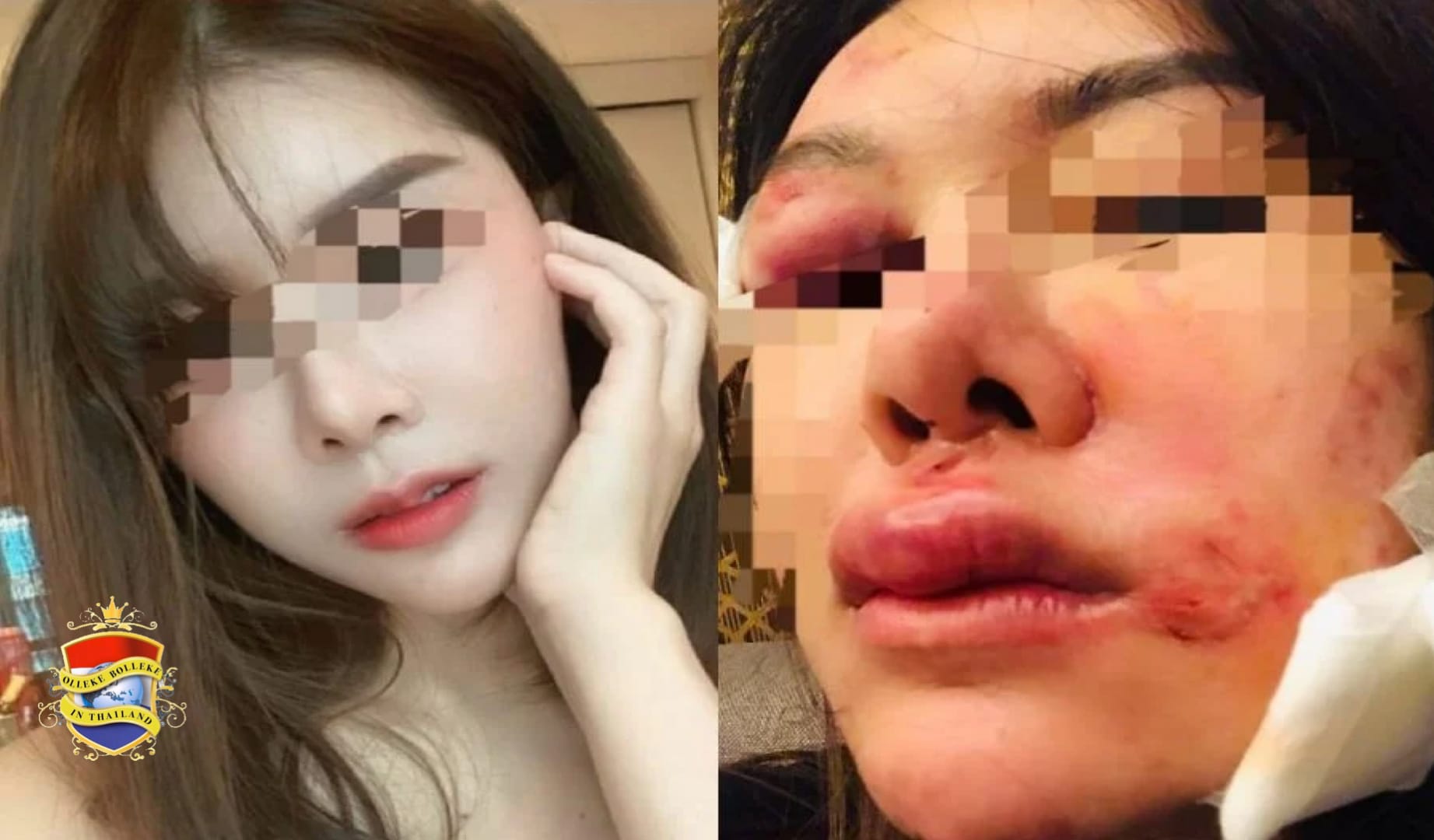 Vrouw in Oost-Thailand op wrede wijze door vriend gebeten nadat ze weigerde met hem een borrel te gaan drinken