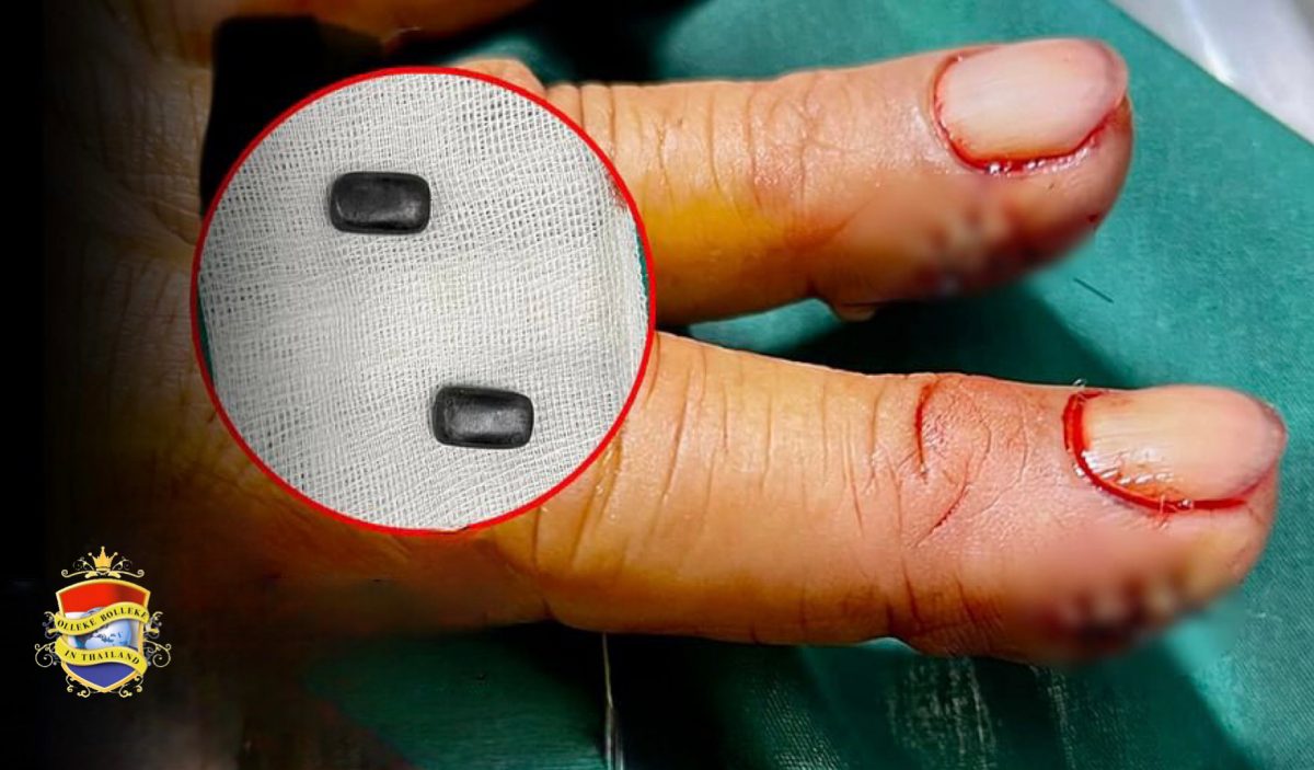 Man in Thailand implanteerde magneetjes in zijn vingers om 40 jaar lang vals te spelen bij het illegale dobbelspel Hi-Lo
