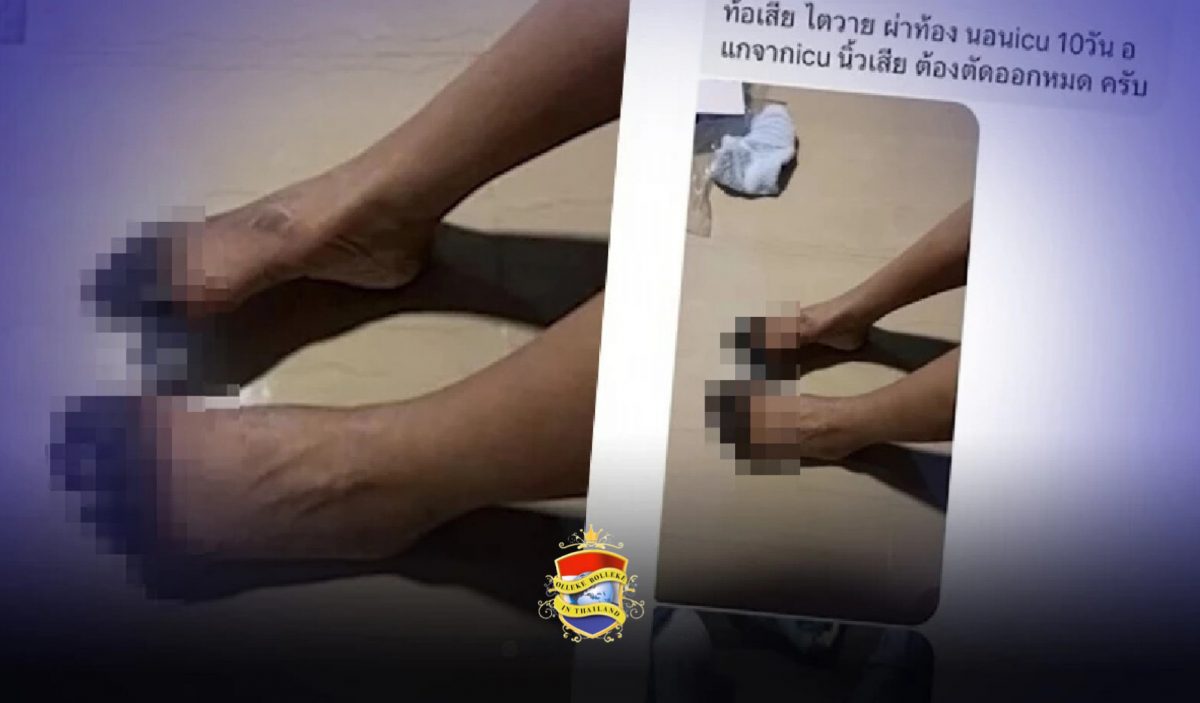 De vingers en tenen van een Thaise vrouw die vanwege diarree zijn geamputeerd tijdens een ziekenhuisbezoek, leiden tot verontwaardiging
