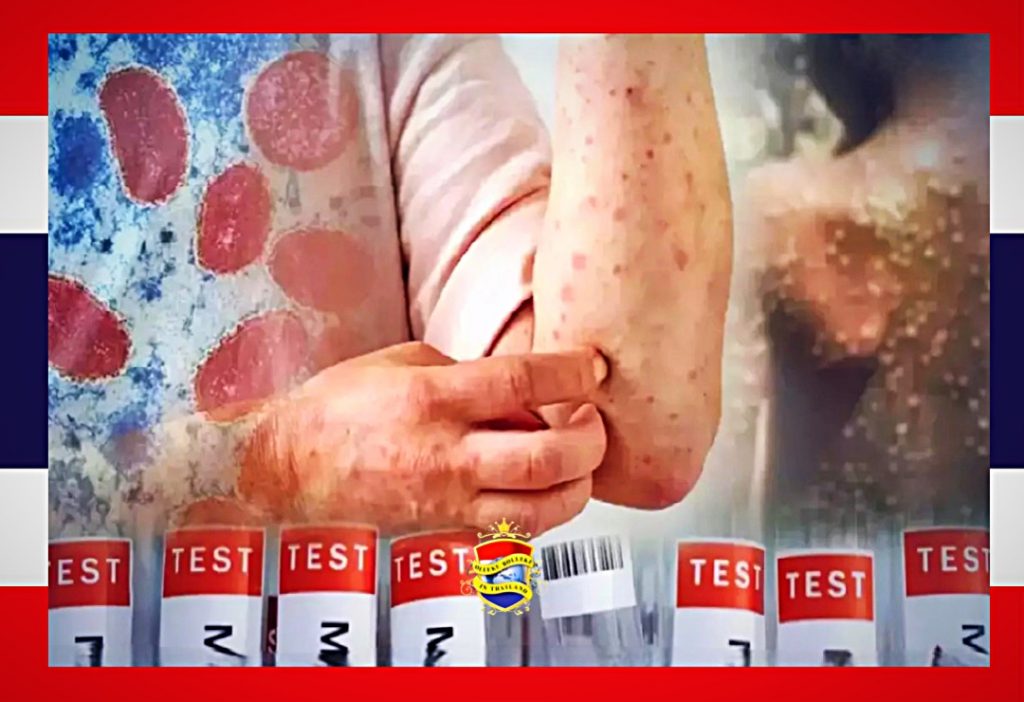 In 19 provincies in Thailand is de apenpokken ziekte vastgesteld, de gay-community wordt aangespoord om veilige seks te beoefenen