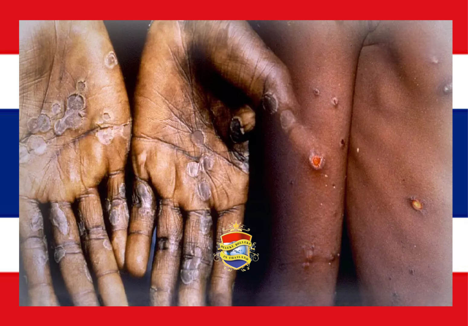 Significante stijging van gevallen van apenpokken onder jongeren in Thailand