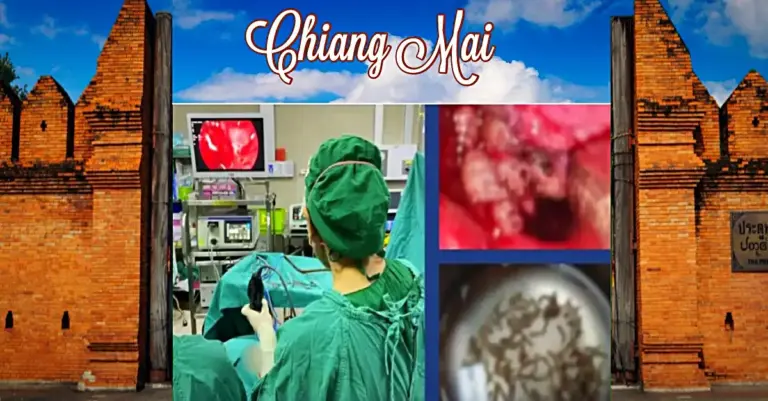 Een vrouw in Noord-Thailand bleek honderden maden in haar  verstopte neusgaten te hebben.