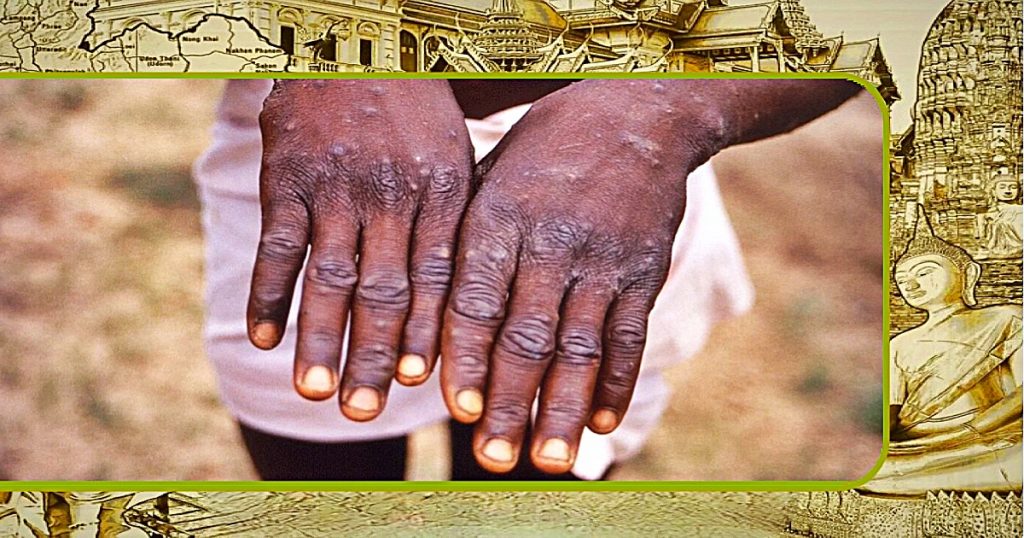 Thailand in staat van paraatheid nu de WHO noodtoestand voor het apenpokkenvirus overweegt