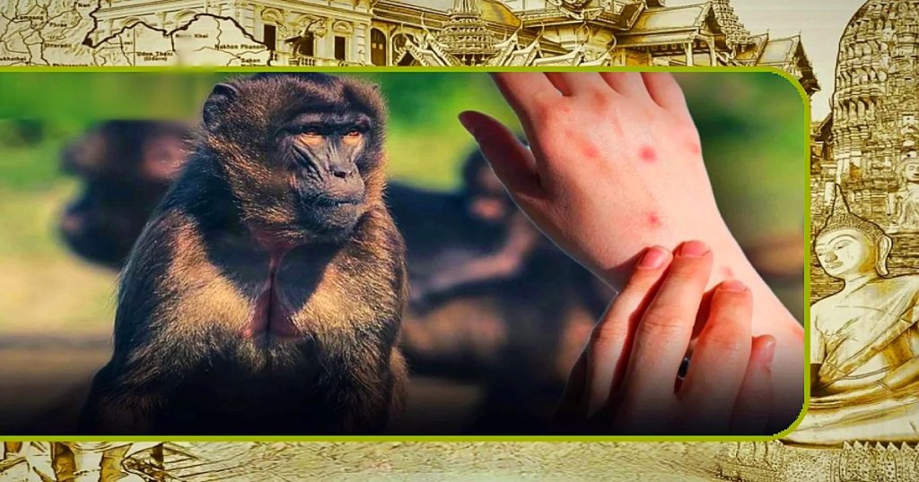 Thailand houdt Mpox nauwlettend in de gaten, nu het aantal gevallen wereldwijd toeneemt