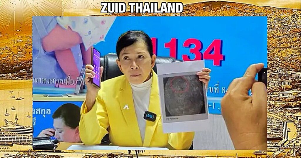Vrouw in Thailand lijdt 18 jaar pijn nadat verpleegster een naald in vagina laat zitten