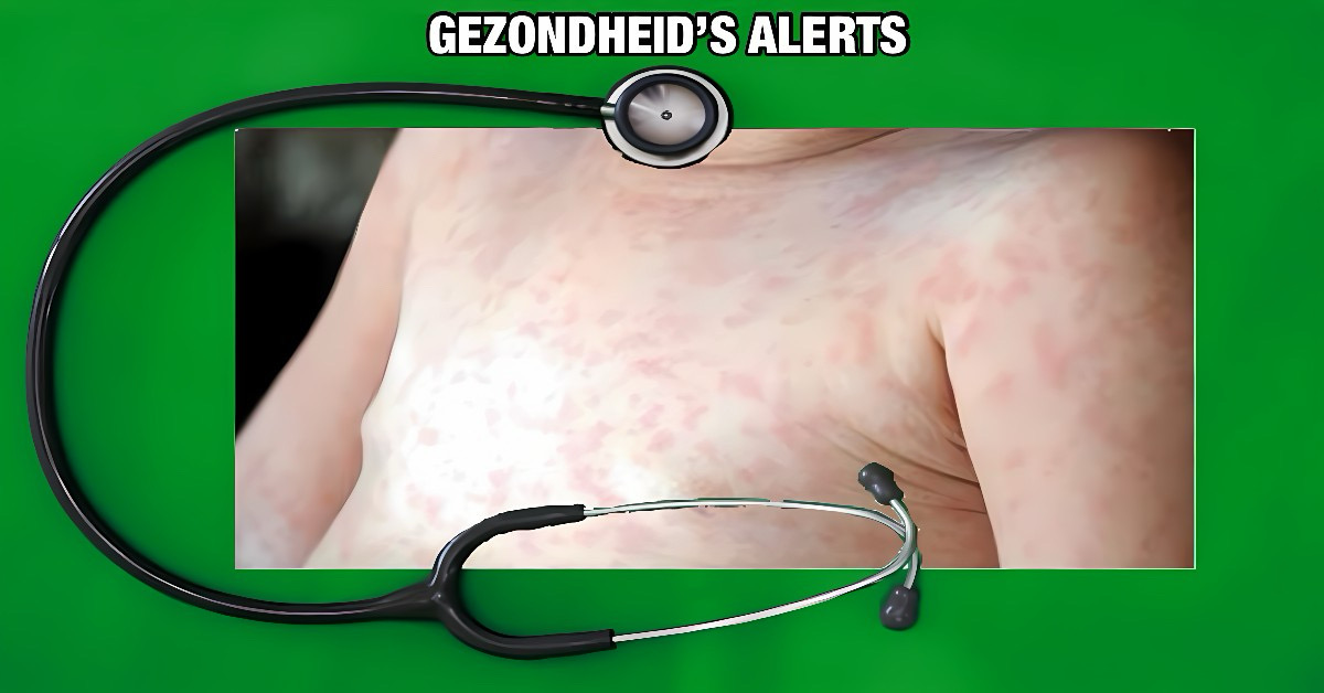 Thailand alert op een eventuele uitbraak van de mazelziekte