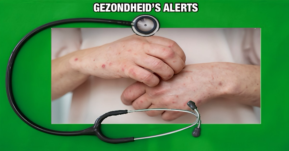 Thailand houdt het virus “Mpox” extra in de gaten, vooral in toeristische gebieden